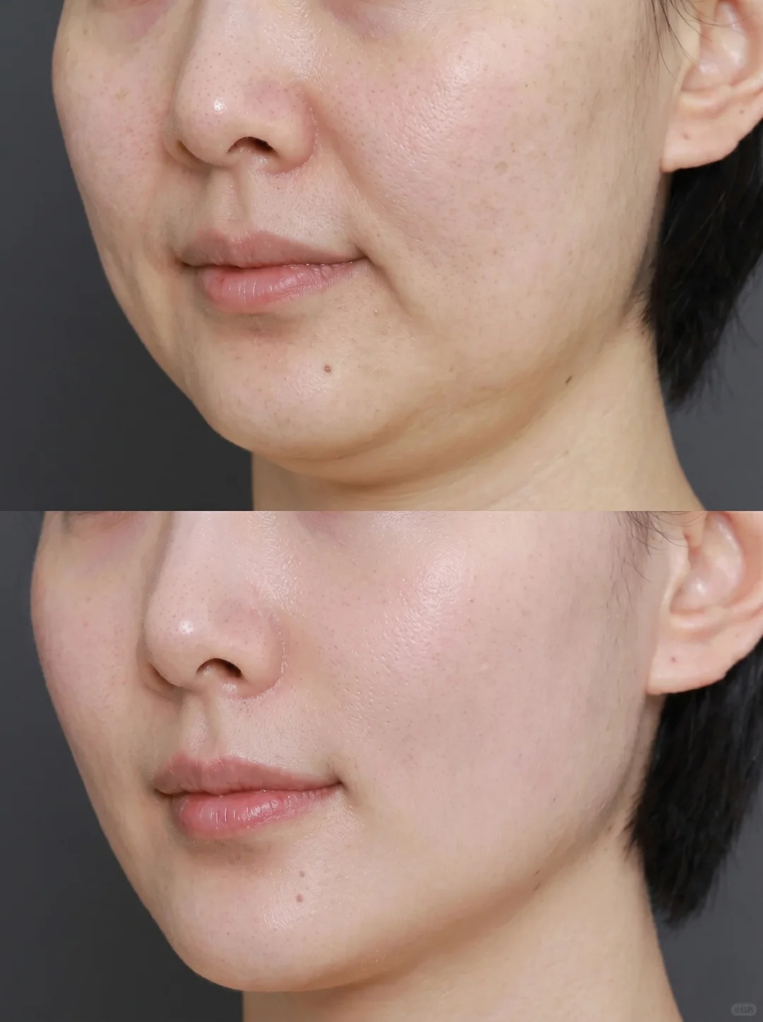 HALO skin rejuvenation results